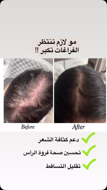 دعم كثافة الشعر - د. هتان قدسي